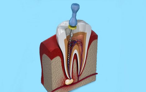 Is Your Tooth Aching? Root Canal Treatment Can Help