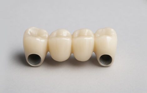 How to Fix a Broken Bridge Tooth: Your Options Explained