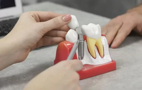 Can Upper Jaw Dental Implants Work Without Enough Bone?